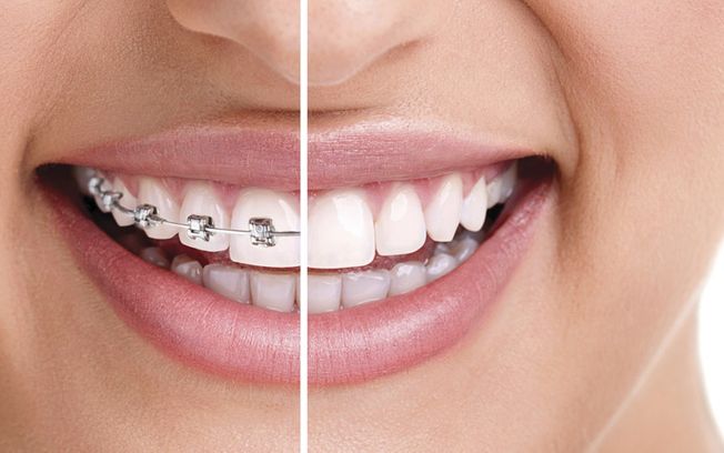 [company_name_branding] Estudio del caso para tratamiento de ortodoncia invisible 