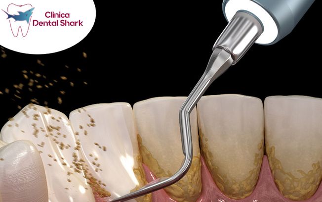 [company_name_branding] Limpieza dental profesional